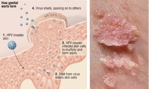 The-17-Most-Important-Things-to-Know-About-Human-Papillomavirus-HPV